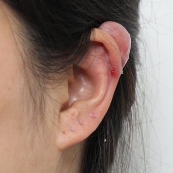 Ear Keloid Removal and Steroid Injection 3485528