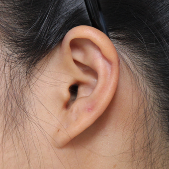 Ear Keloid Removal and Steroid Injection after 3485528