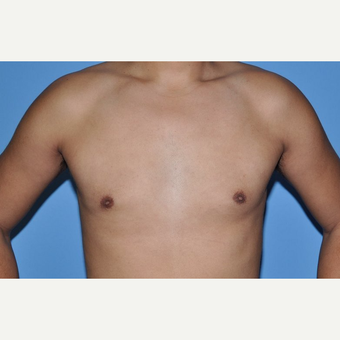 Bilateral Gynecomastia Correction after 2969840