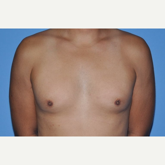 Bilateral Gynecomastia Correction before 2969840