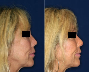 Non Surgical Nose Job before 1431728