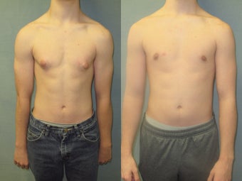 18 Year old male with puffy nipples (small gynecomastia) corrected by Dr. Blau before 1244764