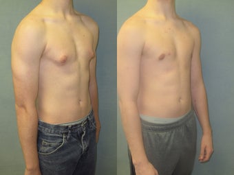 18 Year old male with puffy nipples (small gynecomastia) corrected by Dr. Blau after 1244764
