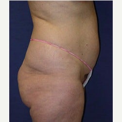 45-54 year old woman treated with Mini Tummy Tuck before 2058486