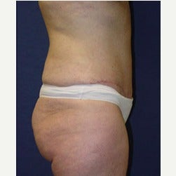 45-54 year old woman treated with Mini Tummy Tuck after 2058486