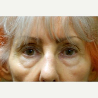 65-74 year old woman treated with Eye Bags Treatment before 2046427