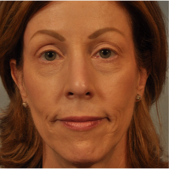 45-54 year old woman treated with Nose Surgery after 3332872