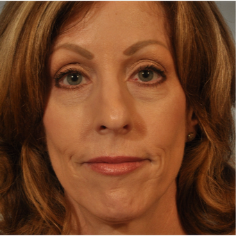 45-54 year old woman treated with Nose Surgery before 3332872