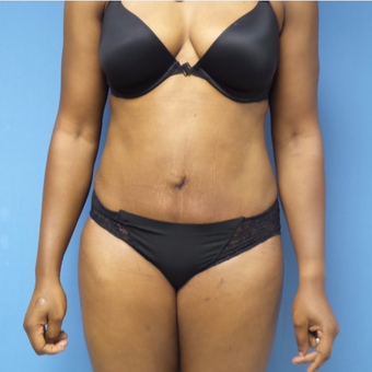 35-44 year old woman treated with Tummy Tuck after 3168461
