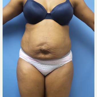 35-44 year old woman treated with Tummy Tuck before 3168461