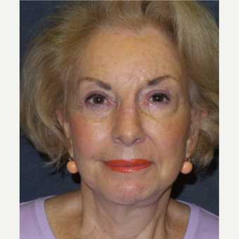 75 and up year old woman treated with Eyelid Surgery after 3466716