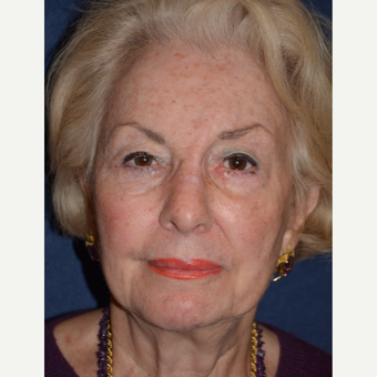 75 and up year old woman treated with Eyelid Surgery before 3466716