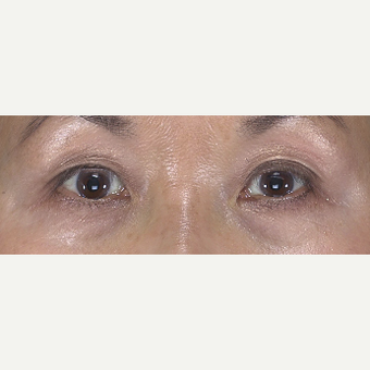 55-64 year old woman treated with Eyelid Surgery before 3482973
