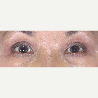 55-64 year old woman treated with Eyelid Surgery after 3482973