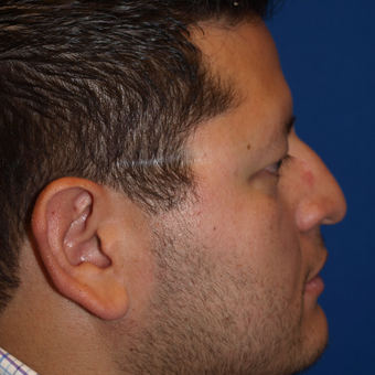 35-44 year old man treated with Rhinoplasty before 3326250