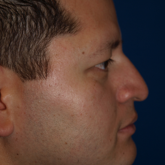 35-44 year old man treated with Rhinoplasty after 3326250