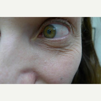 Instant wrinkle removal in 5 minutes before 1852900