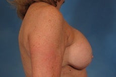 Breast Lift before 923941