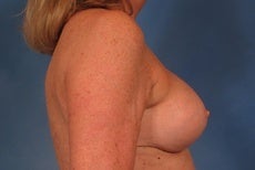 Breast Lift after 923941