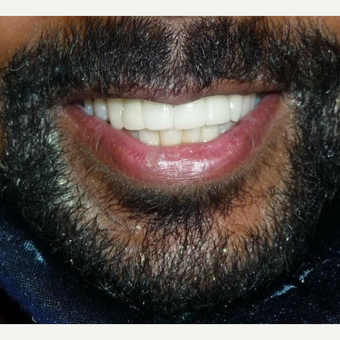25-34 year old male treated with Smile Makeover after facial trauma accident after 3014537