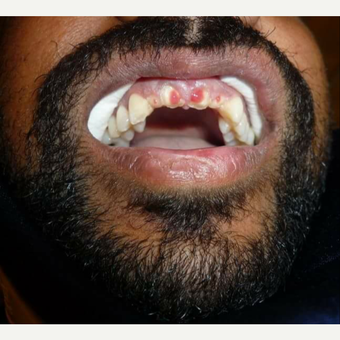 25-34 year old male treated with Smile Makeover after facial trauma accident before 3014537