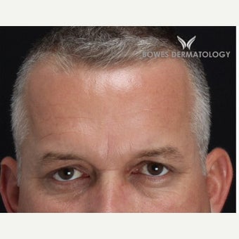 35-44 year old man treated with Wrinkle Treatment 1804202