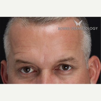 35-44 year old man treated with Wrinkle Treatment after 1804202