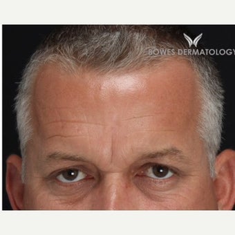 35-44 year old man treated with Wrinkle Treatment 1804202