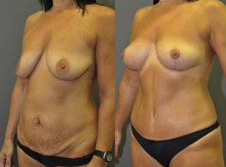 Mastopexy and abdominoplasty - this patient had a "mommy makeover" with no breast implants used 1503778