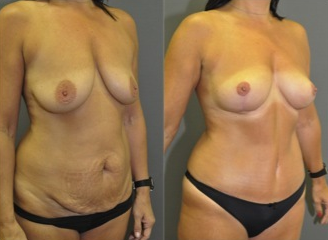 Mastopexy and abdominoplasty - this patient had a "mommy makeover" with no breast implants used after 1503778