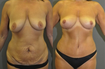 Mastopexy and abdominoplasty - this patient had a "mommy makeover" with no breast implants used before 1503778