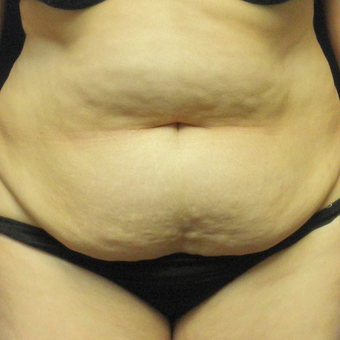 45-54 year old woman treated with Tummy Tuck before 3459208