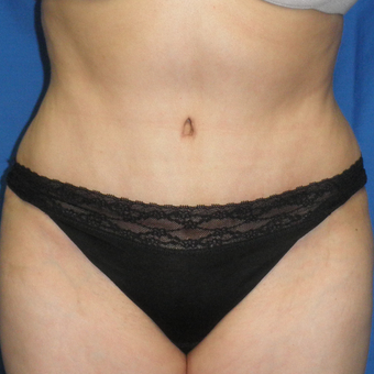 45-54 year old woman treated with Tummy Tuck after 3459208