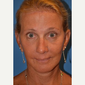45-54 year old woman treated with Brow Lift after 3388553