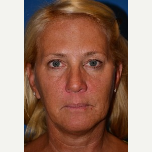 45-54 year old woman treated with Brow Lift before 3388553