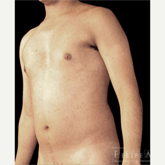 25-34 year old man treated with Abdominal Etching before 3413155
