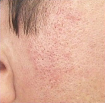 35-44 year old woman treated with Rosacea Treatment after 2119801