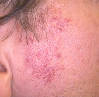 35-44 year old woman treated with Rosacea Treatment before 2119801