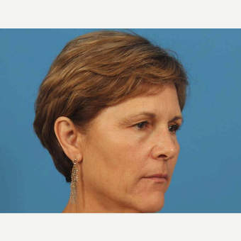 55-64 year old woman treated with TCA Peel before 3787497