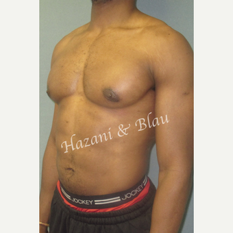 35-44 year old man treated with Male Breast Reduction after 3332987