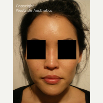 Non Surgical Nose Job on Asian Woman after 2975825