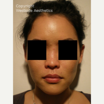 Non Surgical Nose Job on Asian Woman before 2975825