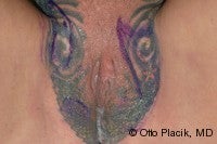 Labia Majora Augmentation with Lipoinjectio before 569485