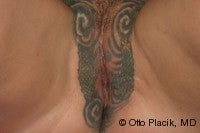 Labia Majora Augmentation with Lipoinjectio after 569485