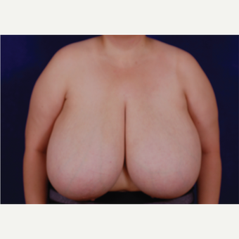 35-44 year old woman treated with Breast Reduction before 3439234