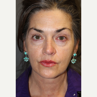 55-64 year old woman treated with Juvederm before 2685040