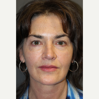 55-64 year old woman treated with Juvederm after 2685040