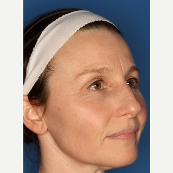 Before and After: Woman treated with IPL after 3711532