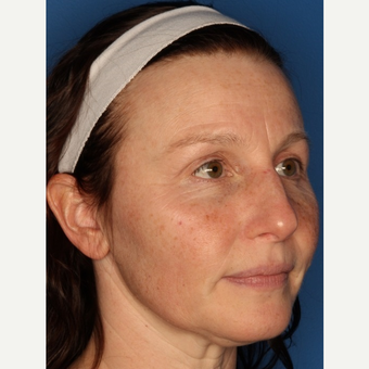 Before and After: Woman treated with IPL before 3711532
