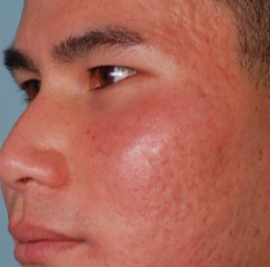 25-34 year old man treated with Acne Scars Treatment before 2465698
